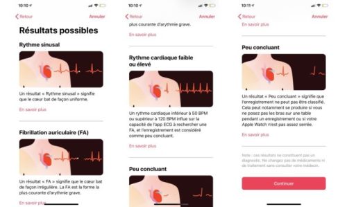 Résultats possibles avec un électrocardiogramme // Source : Numerama