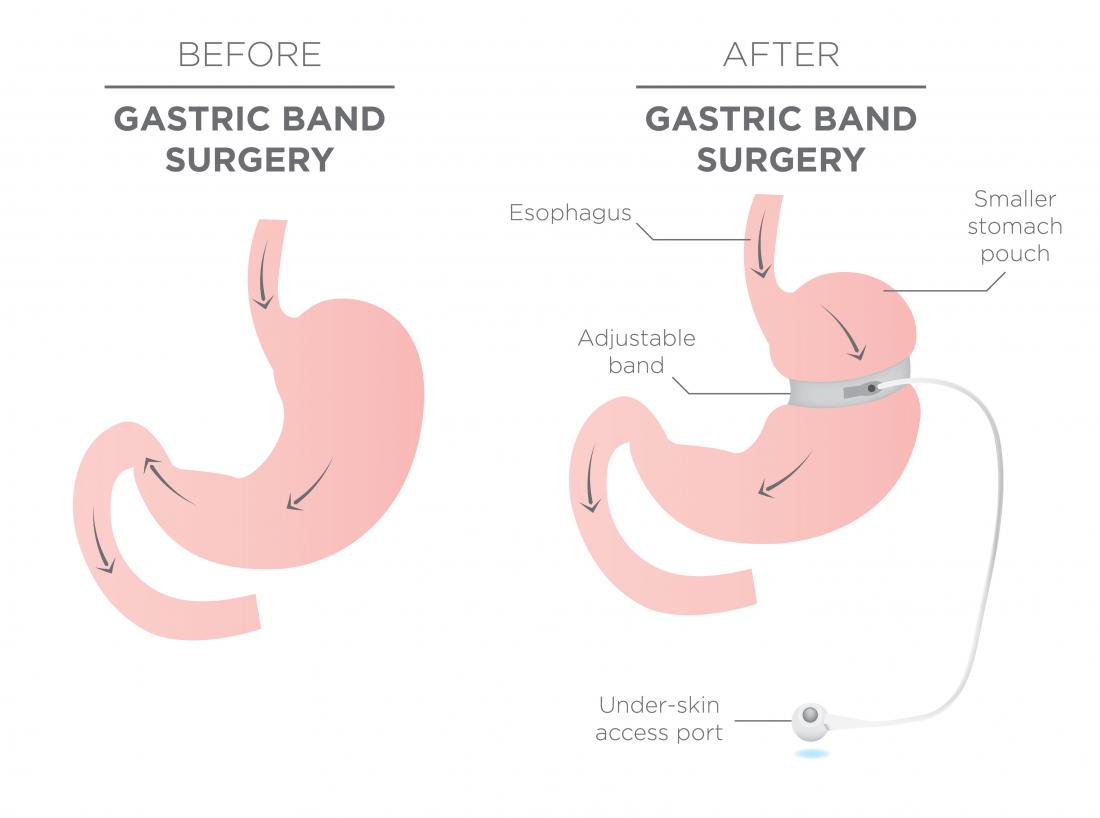 Gastric band surgery