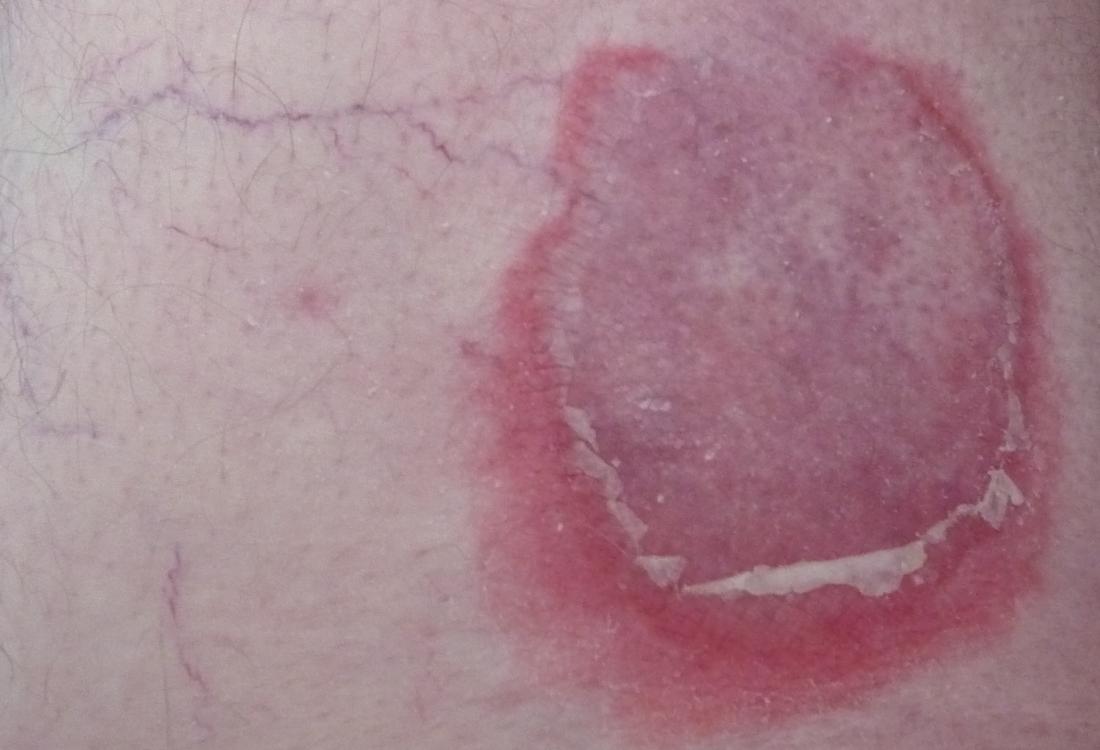 Bullous pemphigoid