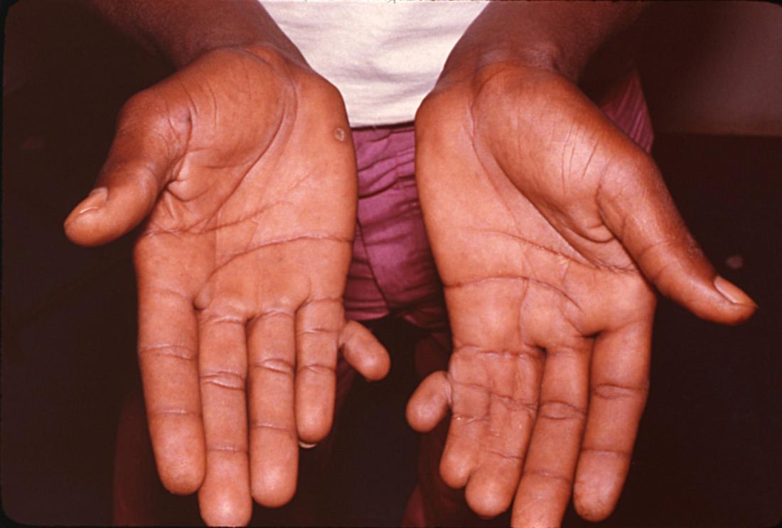 Ulnar or postaxial polydactyly or small finger duplication. Image credit: Radke / Otis Historical Archives of 