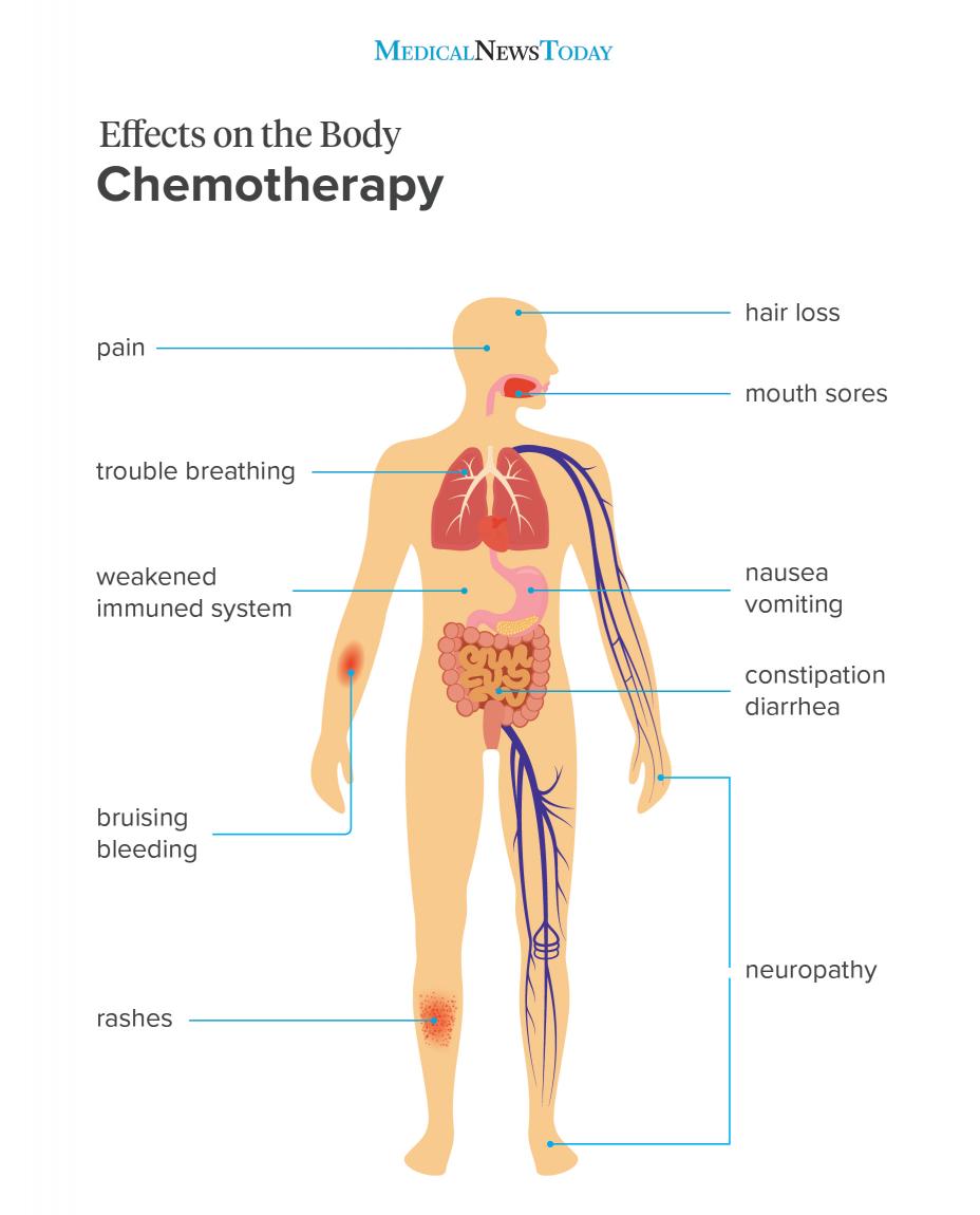 Anatomical illustration pointing out the 10 most common chemotherapy side effects.