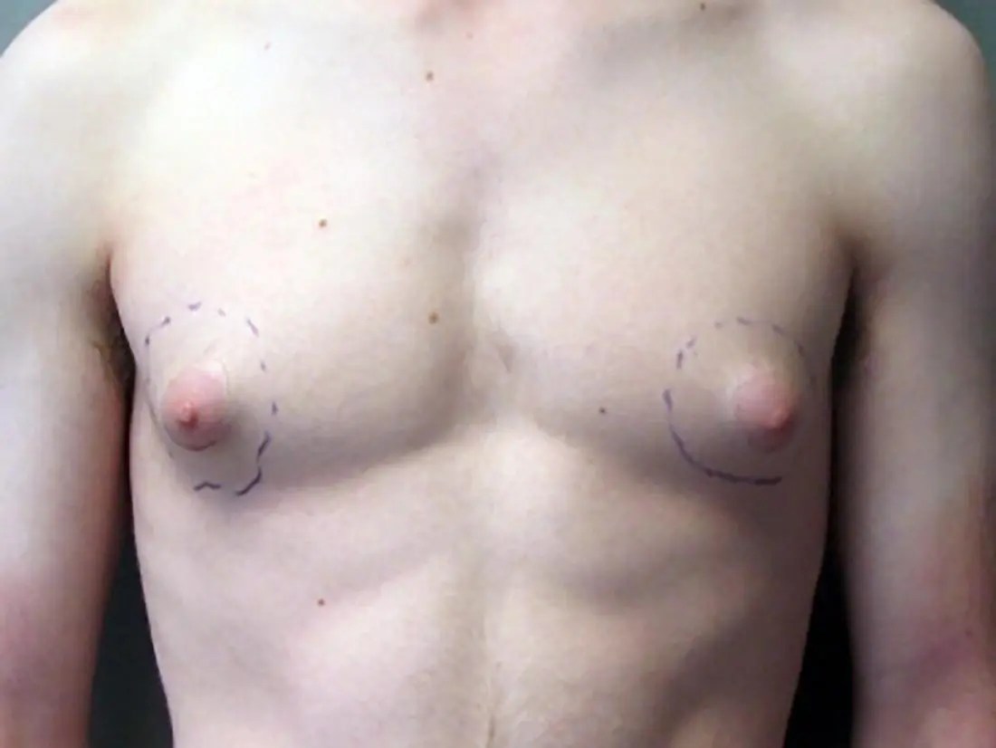 a man with puffy nipples. Image credit: JMZ1122, 2009