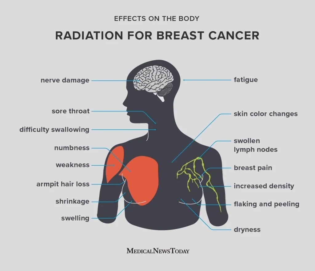 effects-radiation-breast-cancer-eng-1296x2880