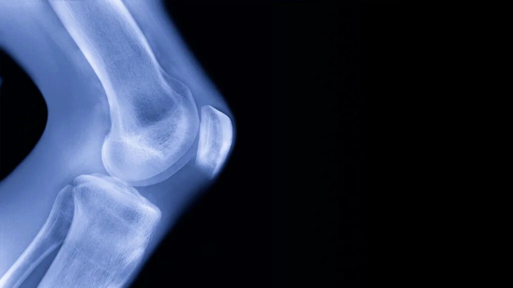 An x-ray of the knee to illustrate hinge joints