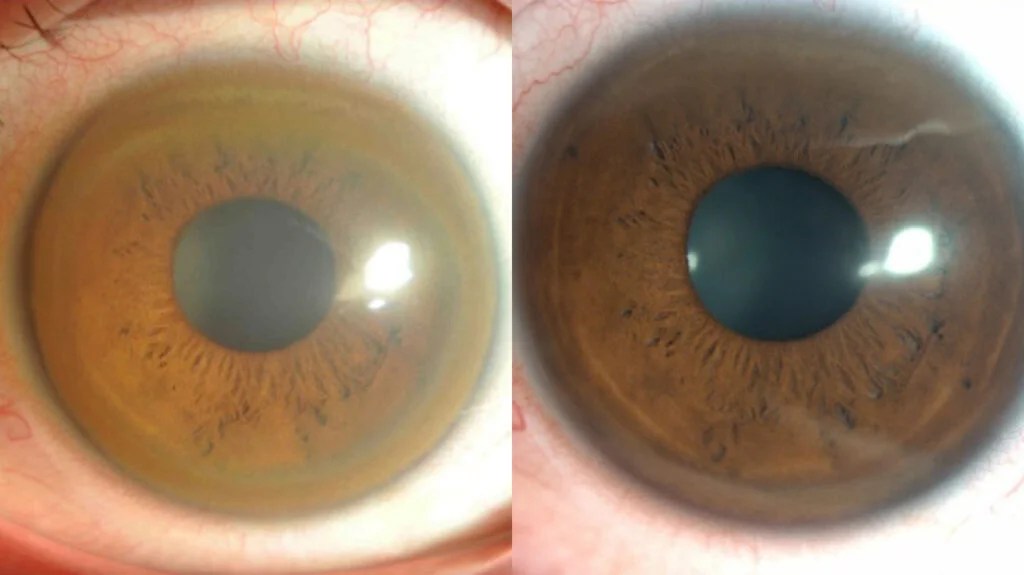 An eye with a kayser-fleischer ring which is a symptom of Wilson's disease.