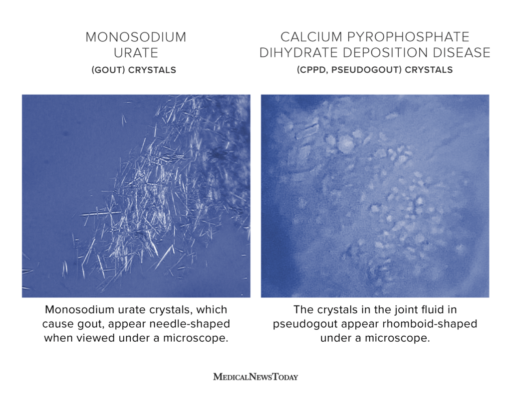 An image of gout crystals, which are needle-shaped, next to an image of CPPD crystals, which are rhomboid in shape.