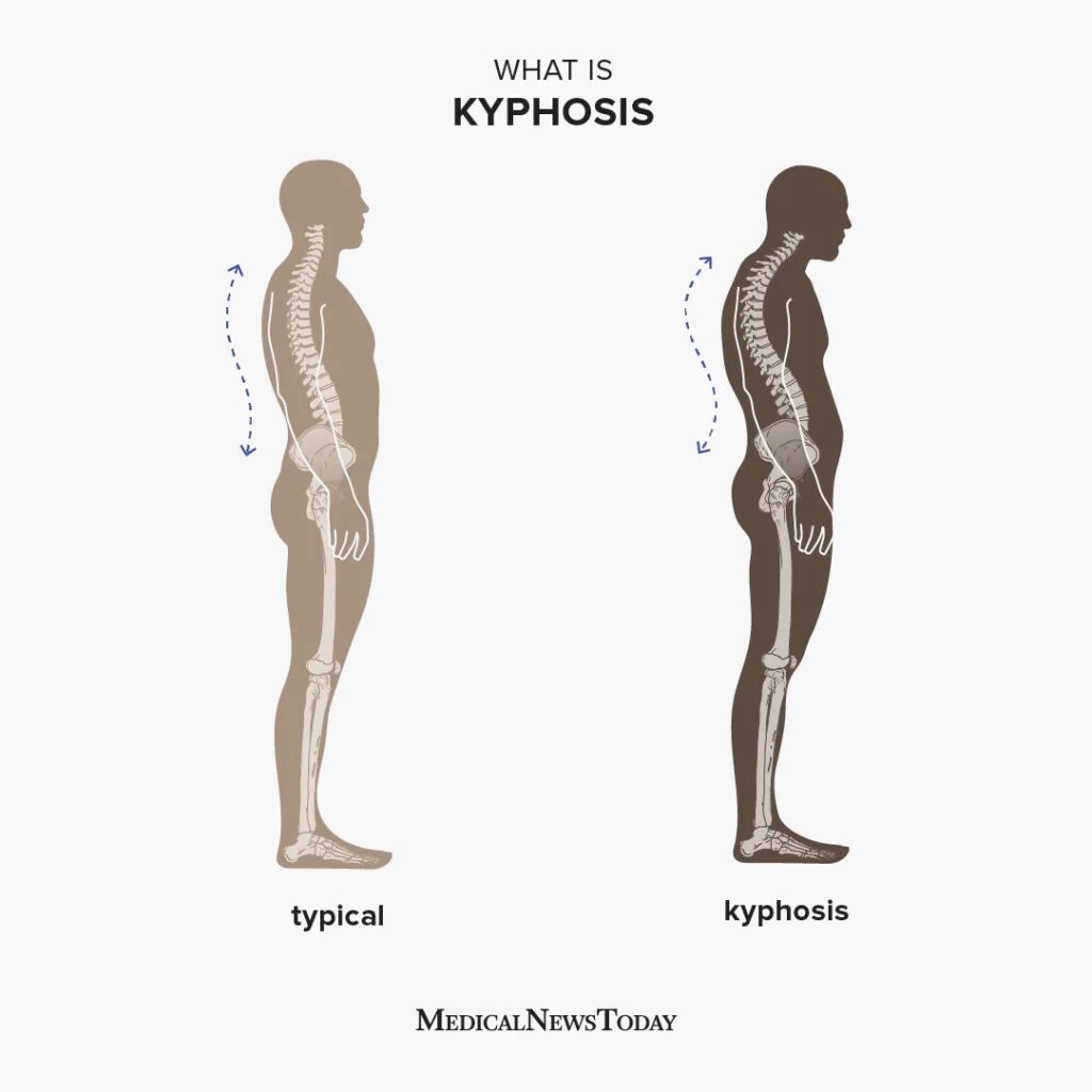 A diagram showing two figures stood in profile. One has kyphosis and the other does not.