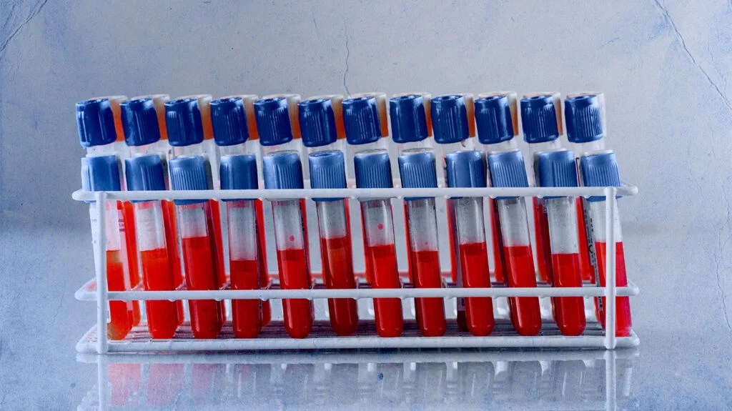 Test tubes containing blood from blood tests