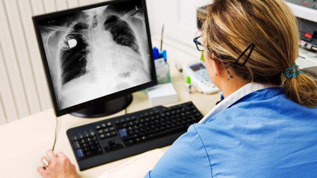 A healthcare professional examining an X-ray of the chest after performing cardiac resynchronization therapy -1.