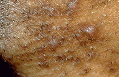 Pseudo folliculitis or razor bumps on the beard area