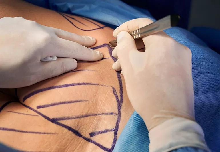 A doctor using a scalpel to cut into a patient who is undergoing surgery