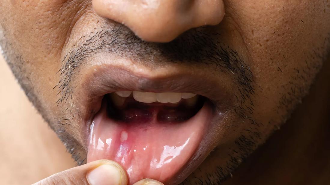 Person pulling bottom lip down to show mouth ulcer