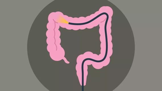 Colonscopy exam showing light inside colon