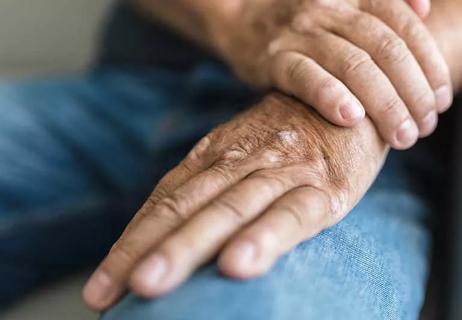 Person holding wrist with psoriatic arthritis.