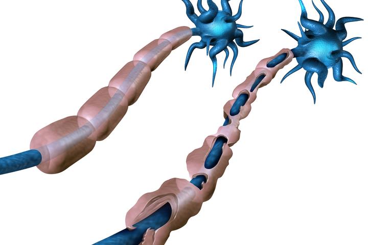 An artist's rendering of healthy nerve (left) with intact myelin, compared to damaged myelin like that in MS
