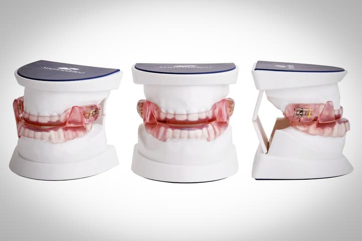 The SomnoDent Flex®, the mandibular advancement device (MAD) used in the study