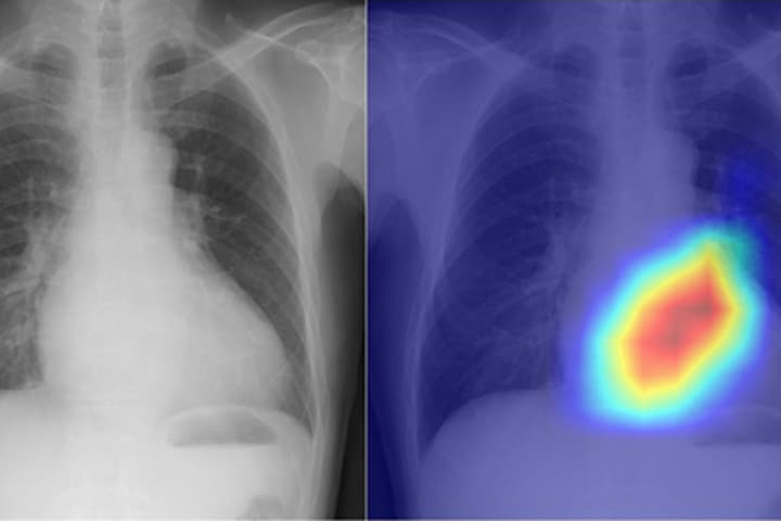 Researchers have used AI to transform the humble chest X-ray into a more powerful diagnostic tool