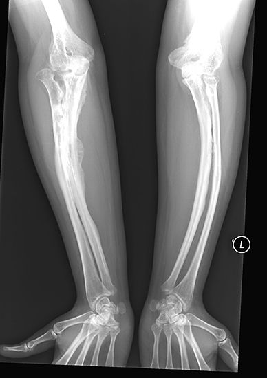 osteogenesis imperfecta