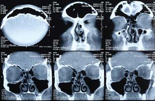 computed tomography (CT) scan