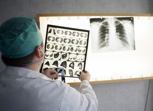 X-rays of patients infected with tuberculosis