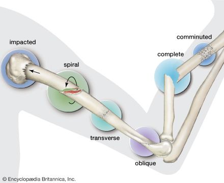 Types of fractures of bones.