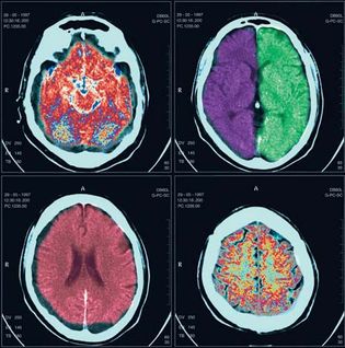 computed tomography (CT) scan