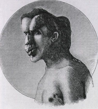 Joseph Merrick