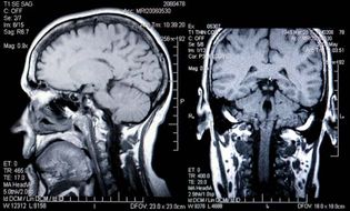 brain scanning; magnetic resonance imaging (MRI)