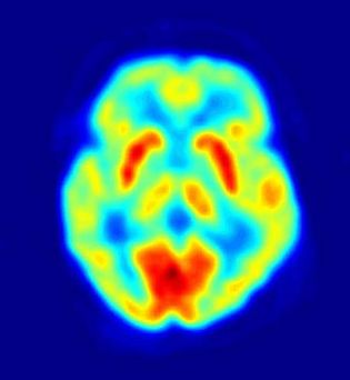 positron emission tomography scan