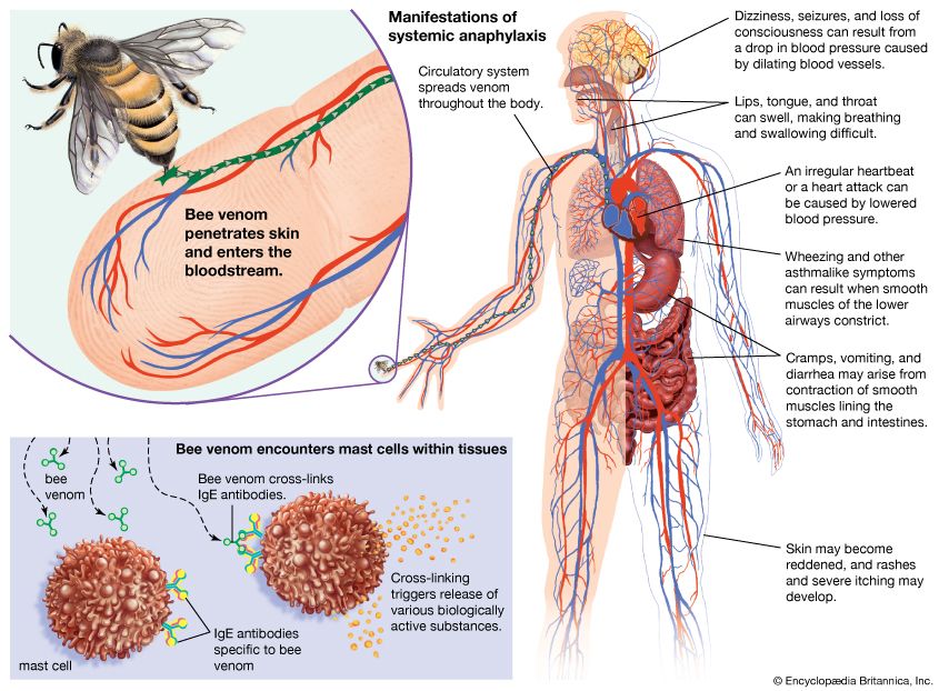 anaphylaxis