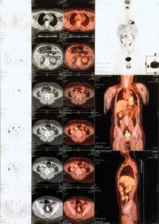 positron emission tomography (PET)