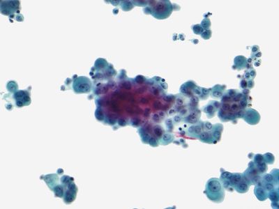 mesothelioma; cancer cell