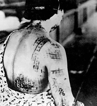 Ionizing radiation injury from atomic bomb