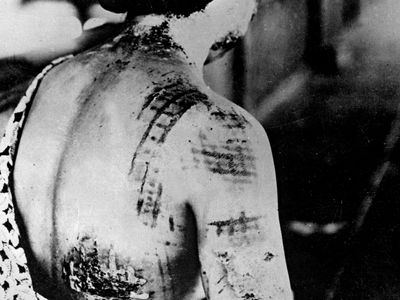 Ionizing radiation injury from atomic bomb