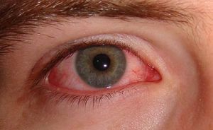 conjunctivitis