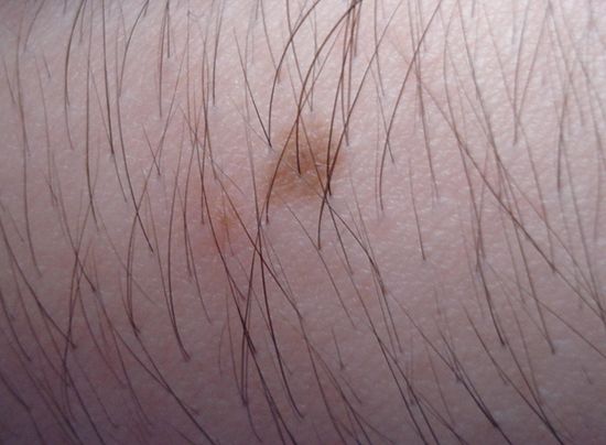 nevus