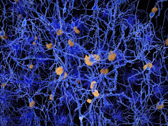 Alzheimer disease; amyloid plaque