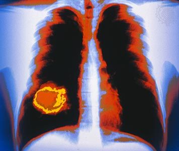 lung cancer