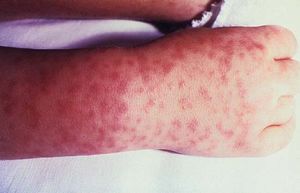 Rocky Mountain spotted fever