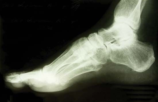 X-ray of foot