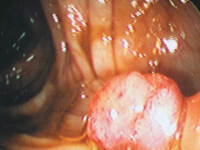 precancerous growth in a human colon