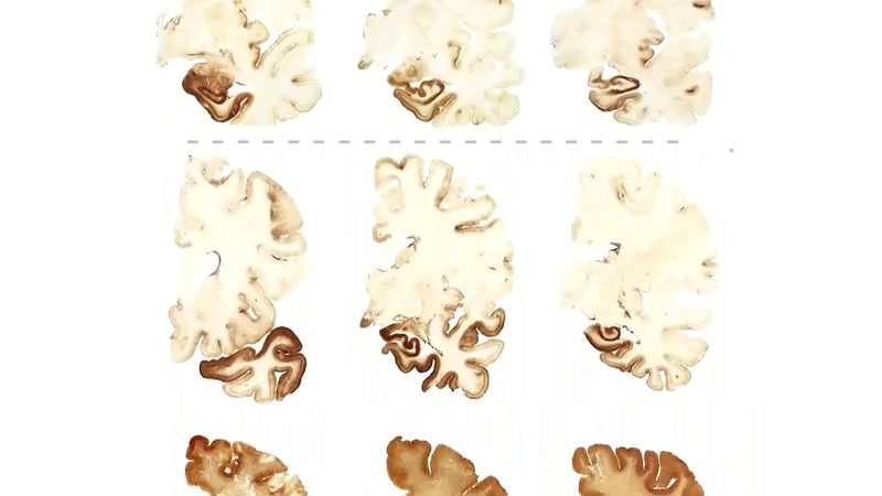 The science behind CTE in athletes and veterans