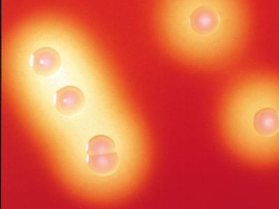 group A beta-hemolytic Streptococcus; rheumatic fever