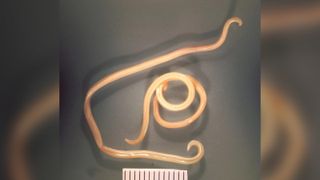 A photo of the roundworm that causes the parasitic infection Toxocariasis.