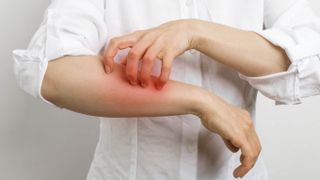 A person in a white shirt scratches their itchy red forearm because they have a scabies infection