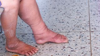 A photo of the legs of a person with lymphedema.