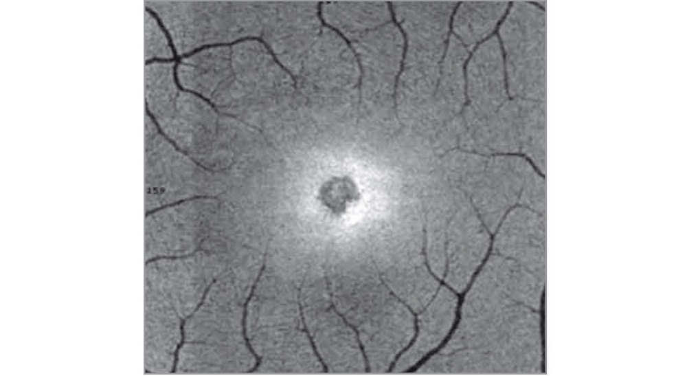 retina, solar retinopathy