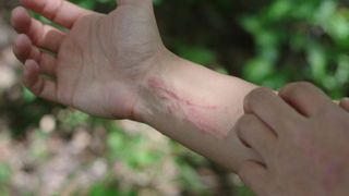 Woman scratching poison ivy rash on arm