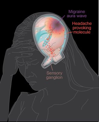 An illustrated diagram of migraine causing molecules around the brain.