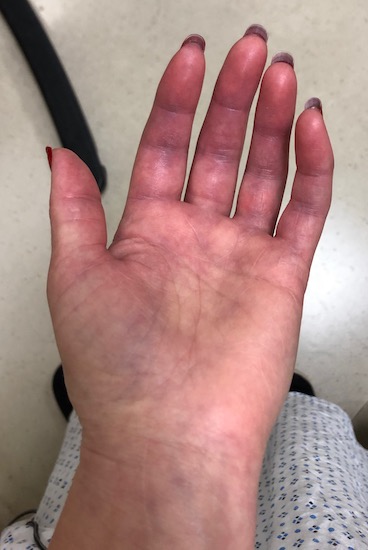 The palm side up of a swollen hand that is turning purple in color